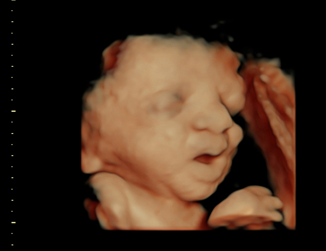 3D ultrasound image at 31 weeks